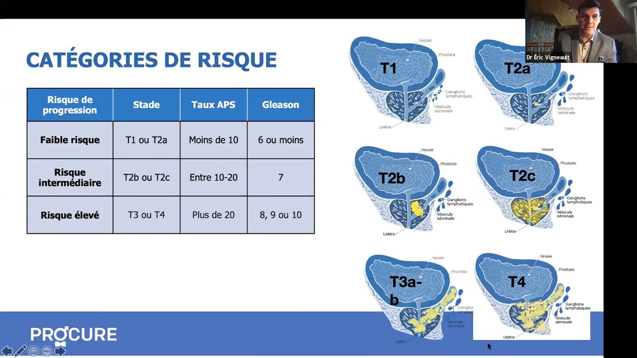 Tout sur la radiothérapie